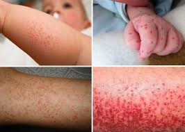 Những lưu ý khi trẻ bị muỗi đốt gây bệnh sốt xuất huyết